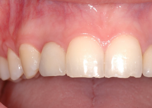 Einzelkrone auf Zahn12