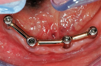 Verankerung für Prothese auf 4 Implantaten mit Stegsystem